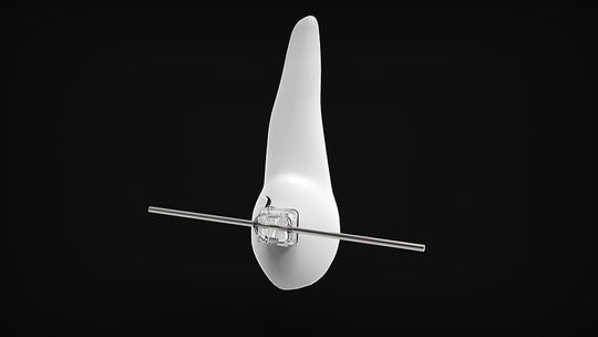 Kompedium wiedzy na temat aparatów ortodontycznych