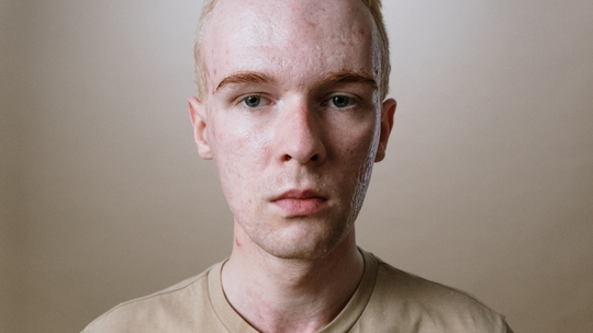 Laserowe usuwanie blizn potrądzikowych