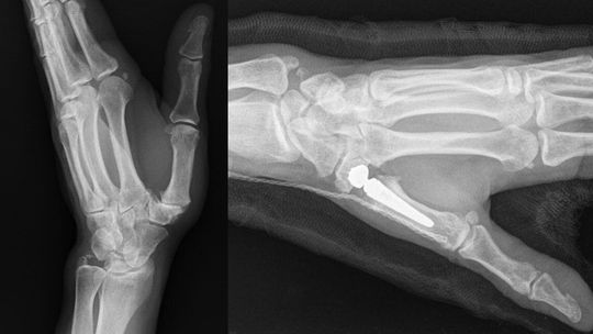 Nowoczesne leczenie bólu kciuka w kozielskim szpitalu! Pełna ruchomość ręki wraca po 6 tygodniach!