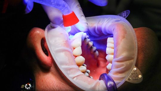 Prosta gama kolorów, perfekcyjne dopasowanie – jak Charisma Classic upraszcza codzienną pracę stomatologa? Prosta gama kolorów, perfekcyjne dopasowanie – jak Charisma Classic upraszcza codzienną pracę stomatologa?