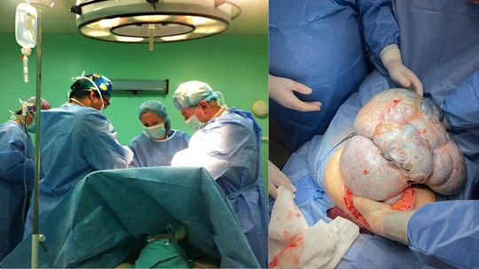 Spektakularna operacja w kozielskim szpitalu. Usunięto 11-kilogramowy guz jajnika