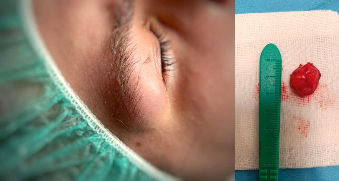 Lekarze z kozielskiej okulistyki usunęli dużego guza z oczodołu