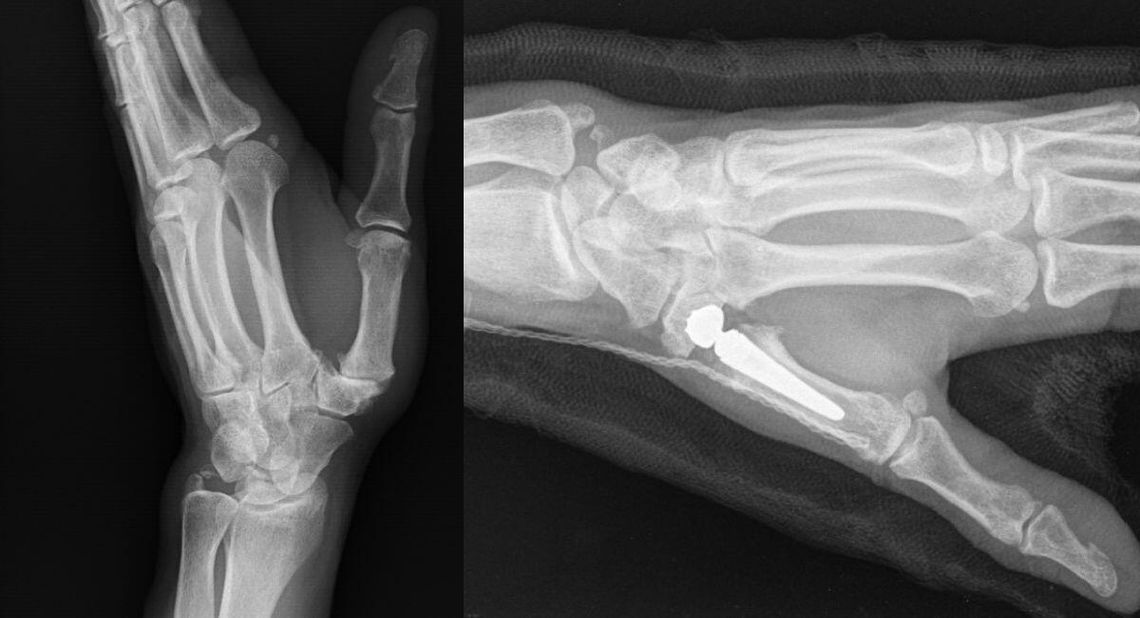 Nowoczesne leczenie bólu kciuka w kozielskim szpitalu! Pełna ruchomość ręki wraca po 6 tygodniach! Nowoczesne leczenie bólu kciuka w kozielskim szpitalu! Pełna ruchomość ręki wraca po 6 tygodniach!