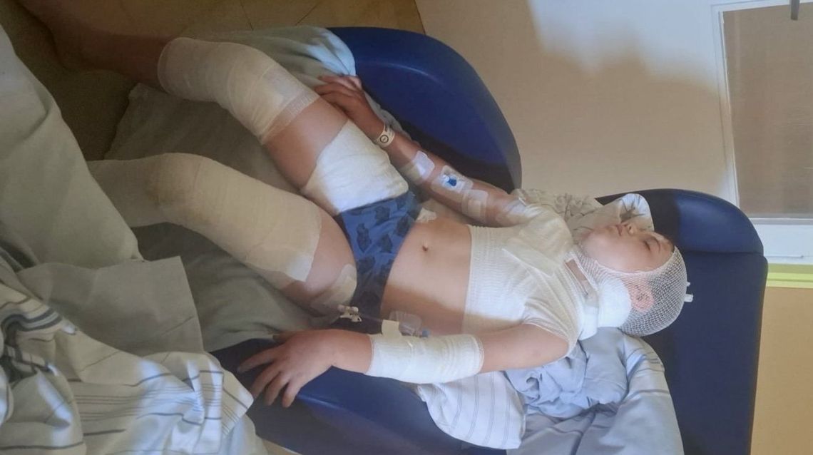 Ruszyła zbiórka na leczenie i rehabilitację Miłosza pogryzionego przez dwa owczarki niemieckie