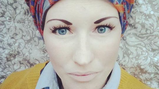 Kobieta cierpiąca na alopecję